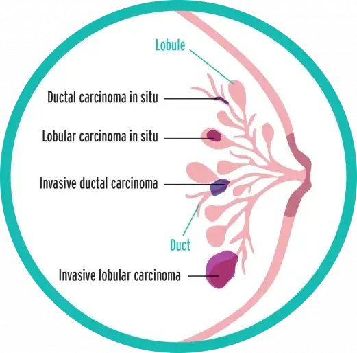Breast Cancer Diagram