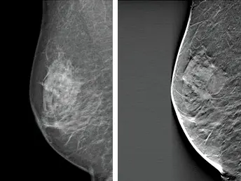 digital vs 3D missed cancer